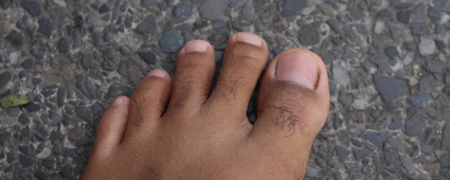 Surgery for Problems of the Small Toes - Sancta Maria